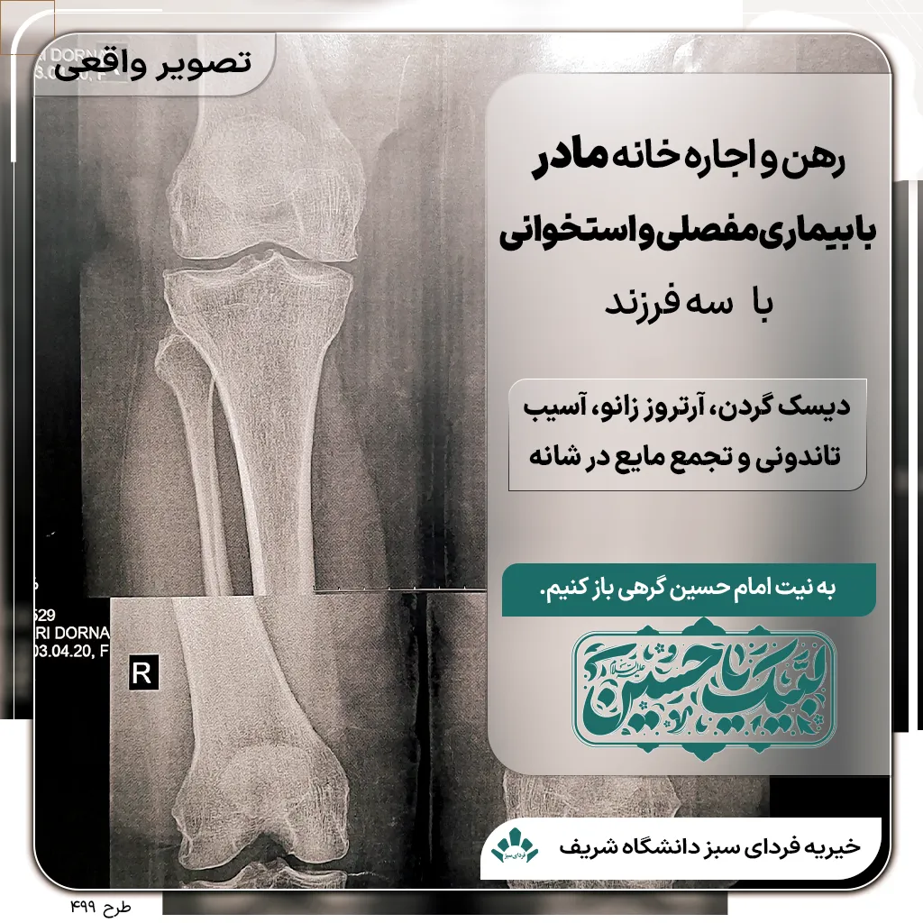 تصویر پزشکی زانوی مادر مبتلا به آرتروز و نیازمند حمایت برای رهن و اجاره خانه