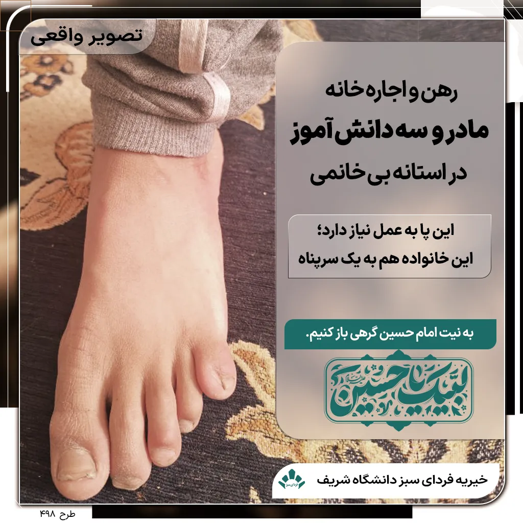 پای آسیب‌دیده کودک دارای گوشت اضافه و نیازمند درمان